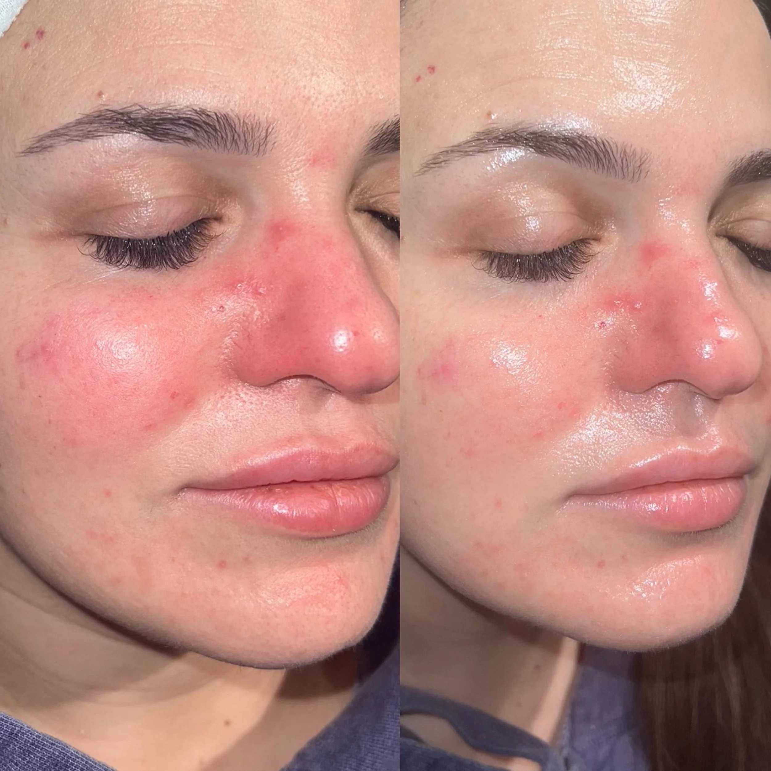 1 x IPL Treatment for Rosacea