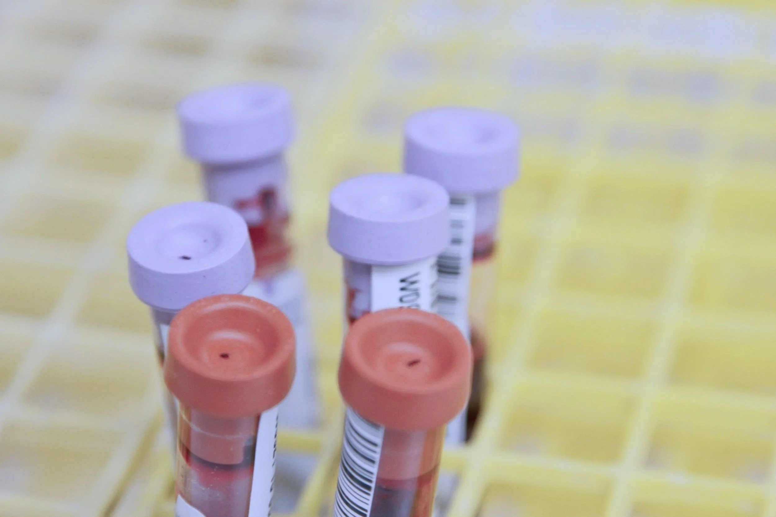 Iron Deficiency Without Anemia: Symptoms, Ferritin, Testing &amp; Treatment