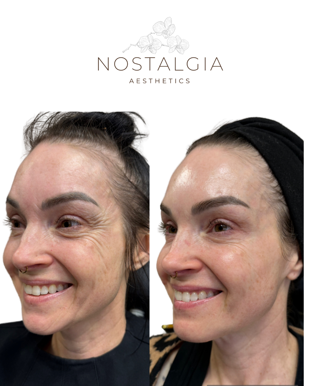 Side-by-side comparison of a woman's face before and after skincare treatment, showing reduced wrinkles, smoother skin, and improved skin texture, with the label 'Nostalgia Aesthetics' at the top.