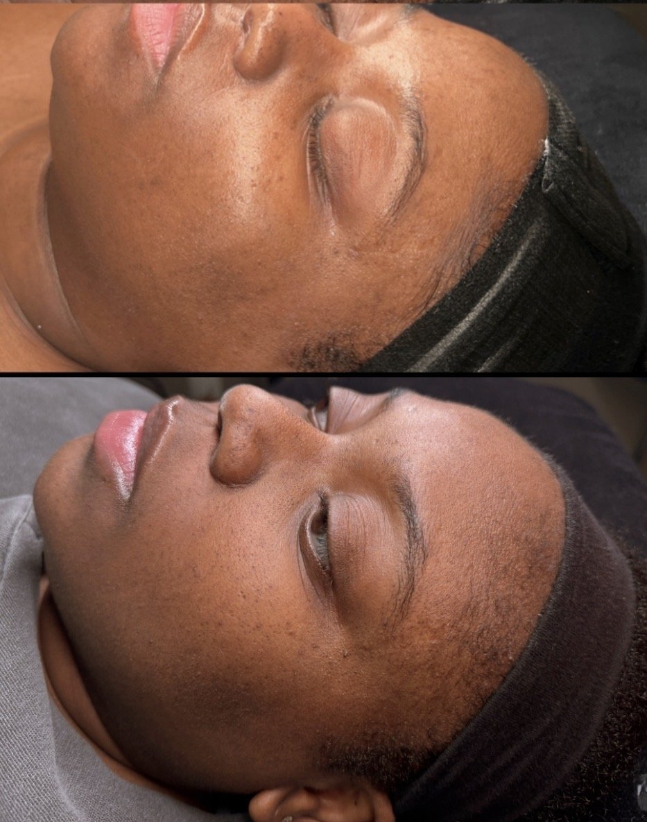 Close-up of a woman lying down with her eyes closed, showing before-and-after results of a skincare treatment on her face.