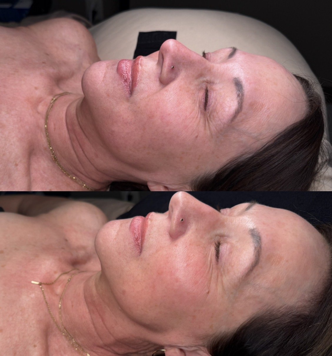 Side-by-side photos of a middle-aged woman lying down, showing skin treatments, with visible improvements in skin texture and appearance.