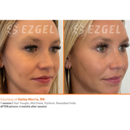 Comparison of a woman's face before and after a tear trough, mid cheek, and nasolabial fold treatment, showing improvements in skin appearance.