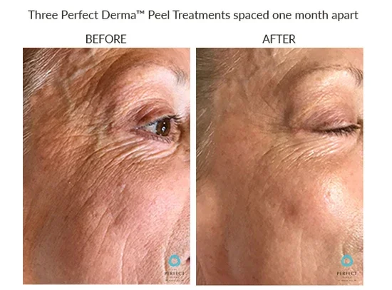 Perfect Derma Peel Wrinkles BA Nostalgia Richfield.webp