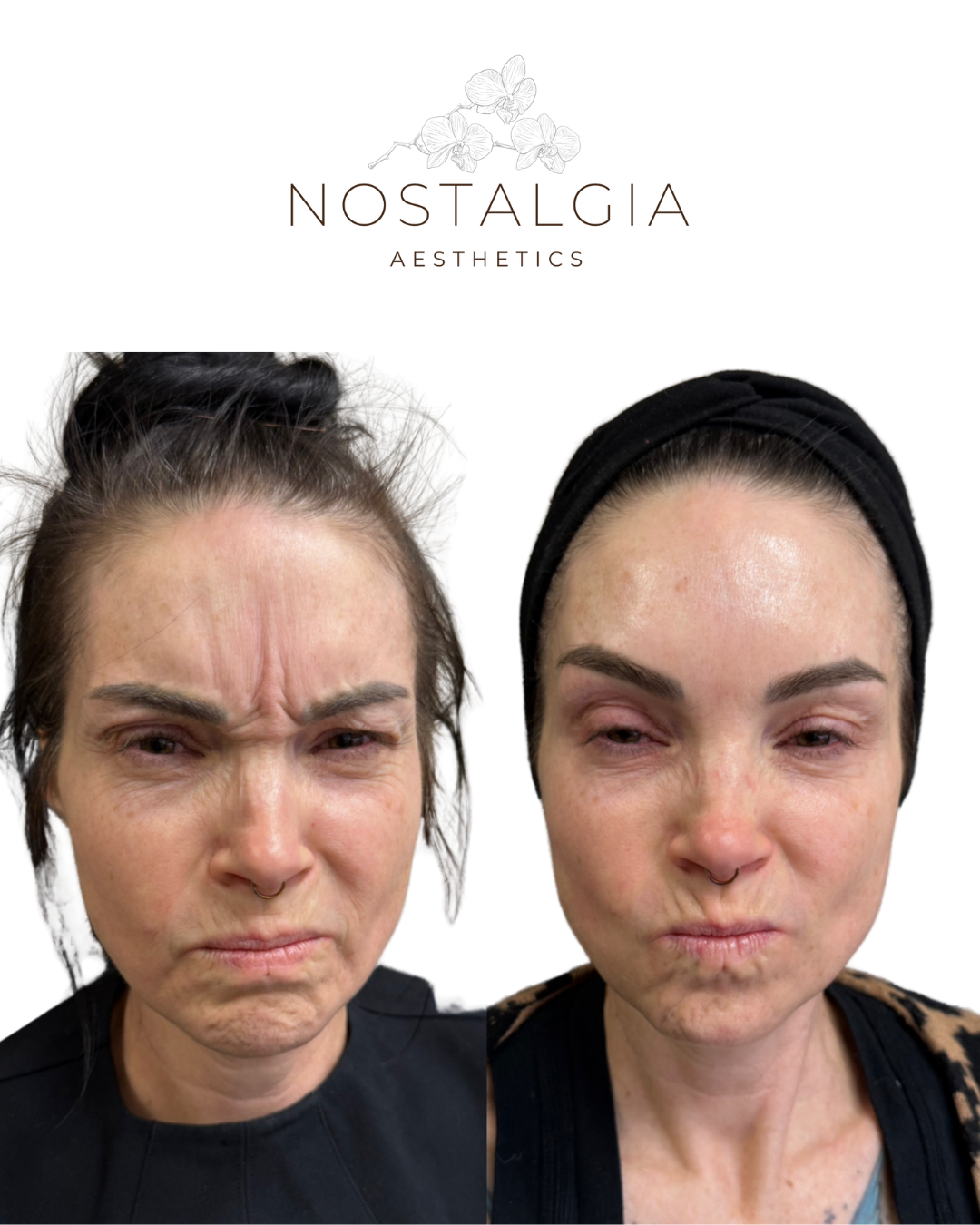 Side-by-side before and after photos of a woman showing improved skin texture and appearance after a skincare treatment, with the logo of Nostalgia Aesthetics at the top.
