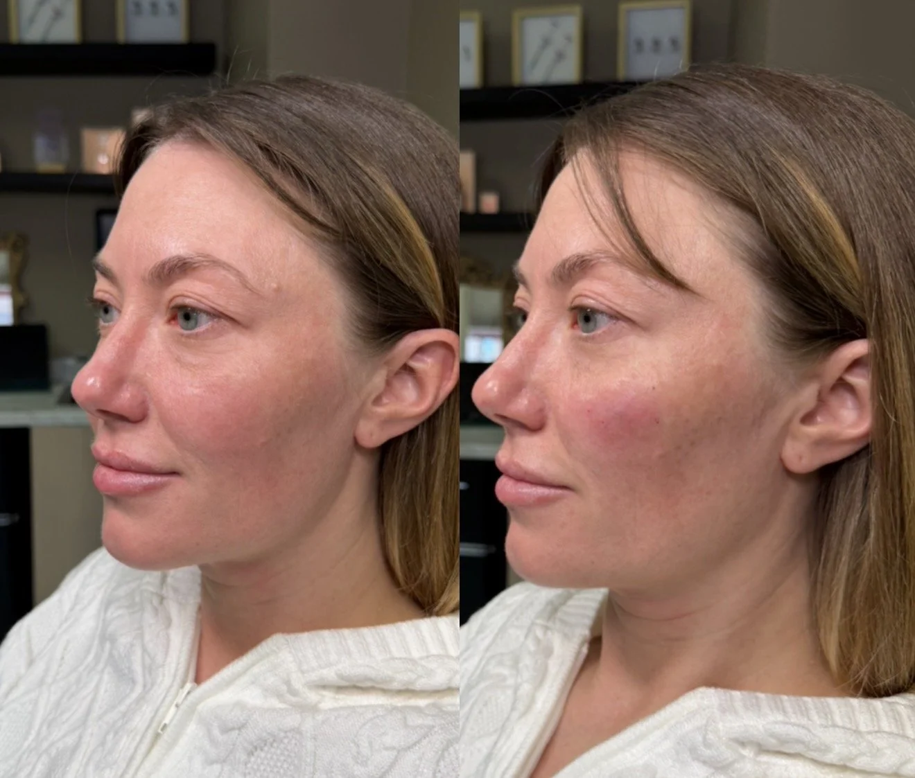 Side-by-side comparison of a woman before and after skincare treatment, showing improved skin texture and redness reduction.