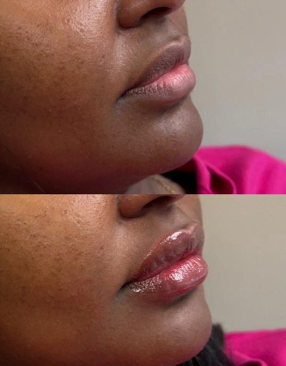 Close-up photos of a woman's lips, showing a before and after comparison of lip gloss or lip enhancement application.
