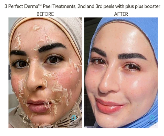 BA Perfect Derma peel Richfield Nostalgia.webp