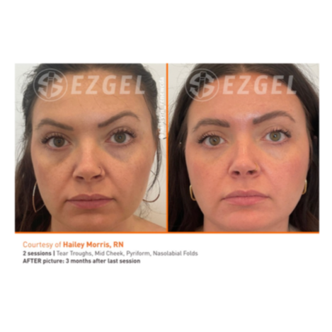 Comparison of a woman's face before and after a cosmetic treatment, showing improvements in skin appearance over three months.