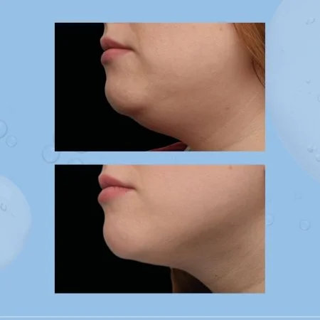 EMFACE® – Submental Lift & Contour