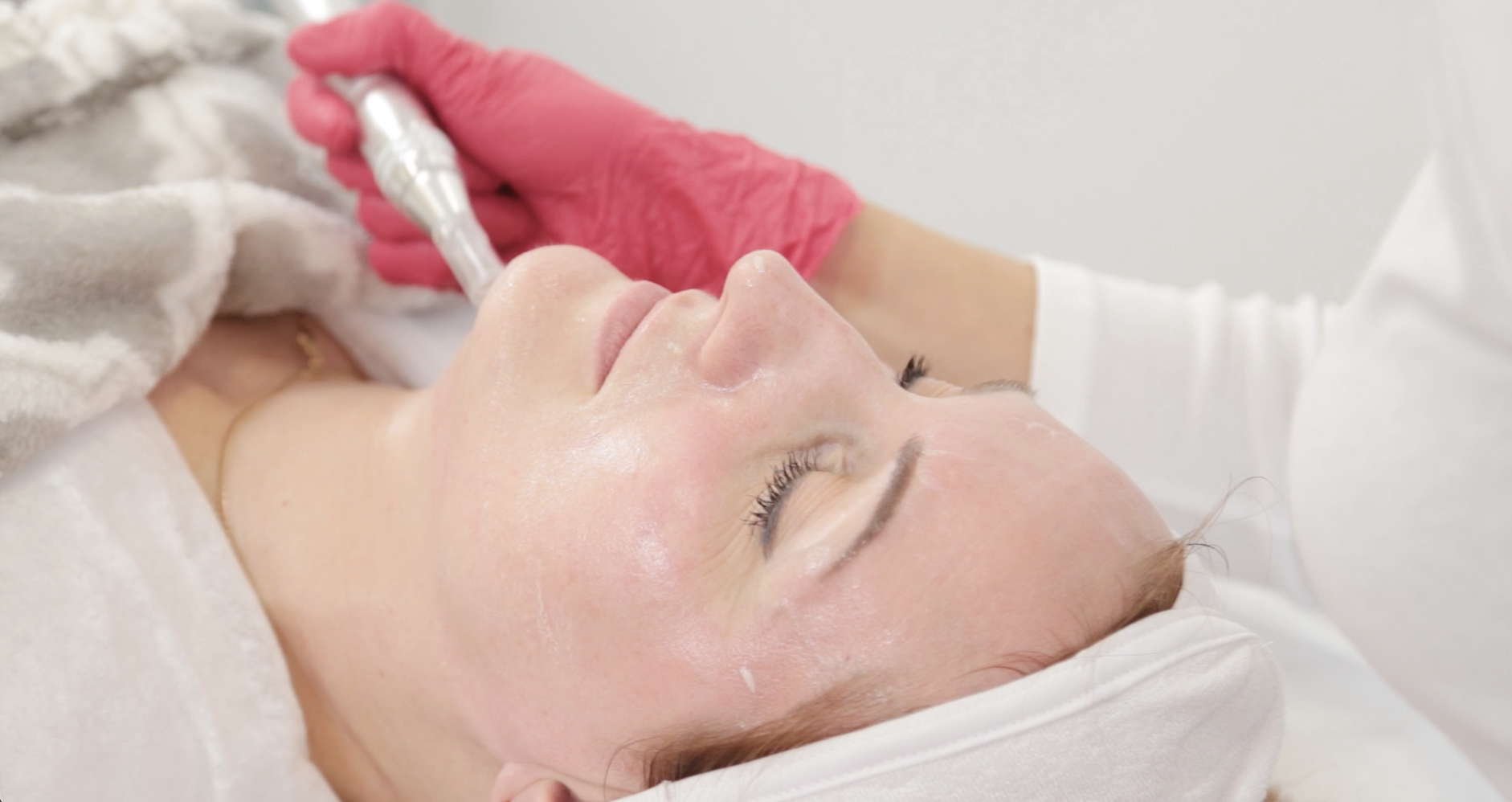 Imagte microneedling from adobe.png