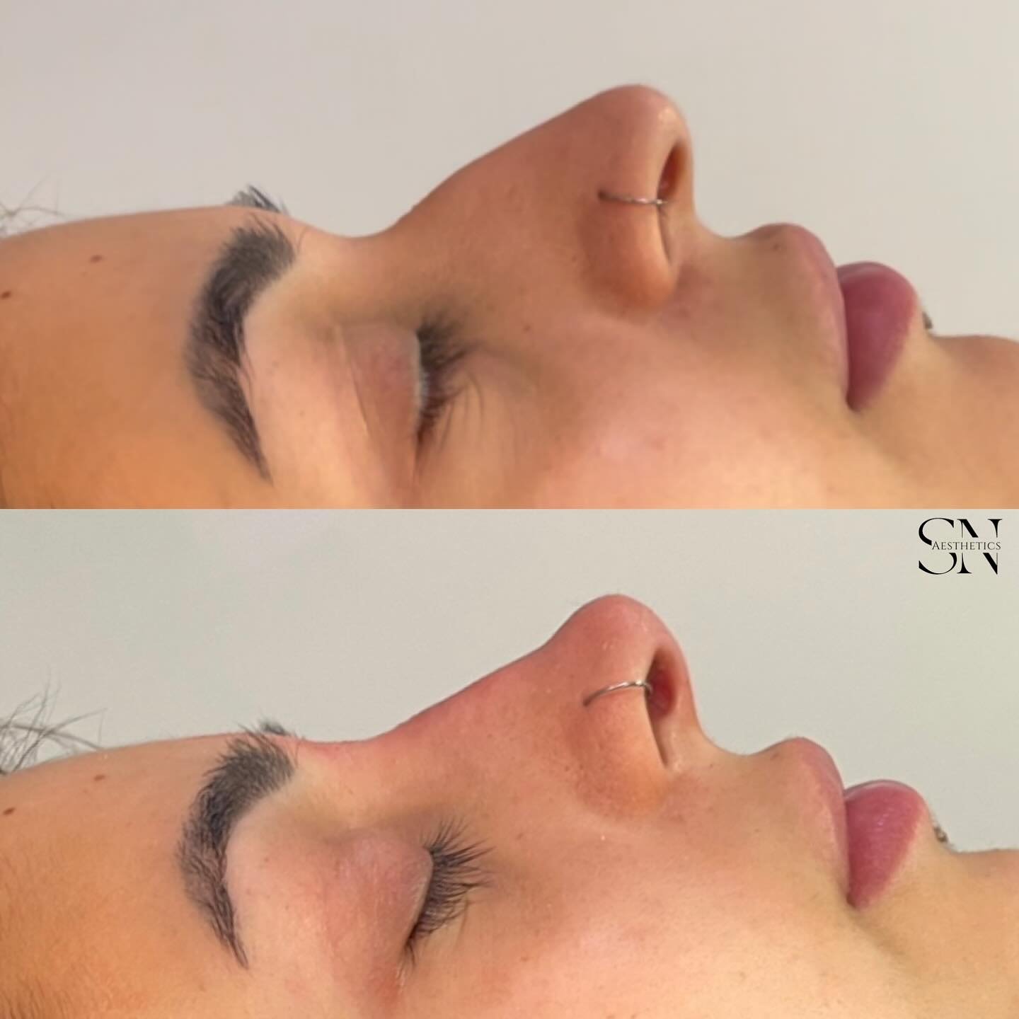 What a great difference some strategically placed filler can make! 🧚&zwj;♀️

Book a FREE non obligation consultation today! 💉 

www.sn-aesthetics.co.uk

#jellynosejob #liquidrhino #juverderm #teoxane #5minnosejob #nonsurgicaltreatments #pixienose #