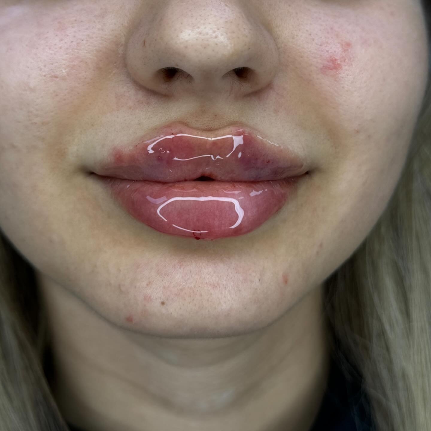 THE BARE NECESSITIES 😆

Would you agree? 💉👄

DM for yours! 💌
.
.
.
.

#lips #lipsofinstagram #lipfillers #dermalfillers #advancedtechniques #russiantechniques #burtonontrent #midlands #artistwiththeneedle #sn_aesthetics