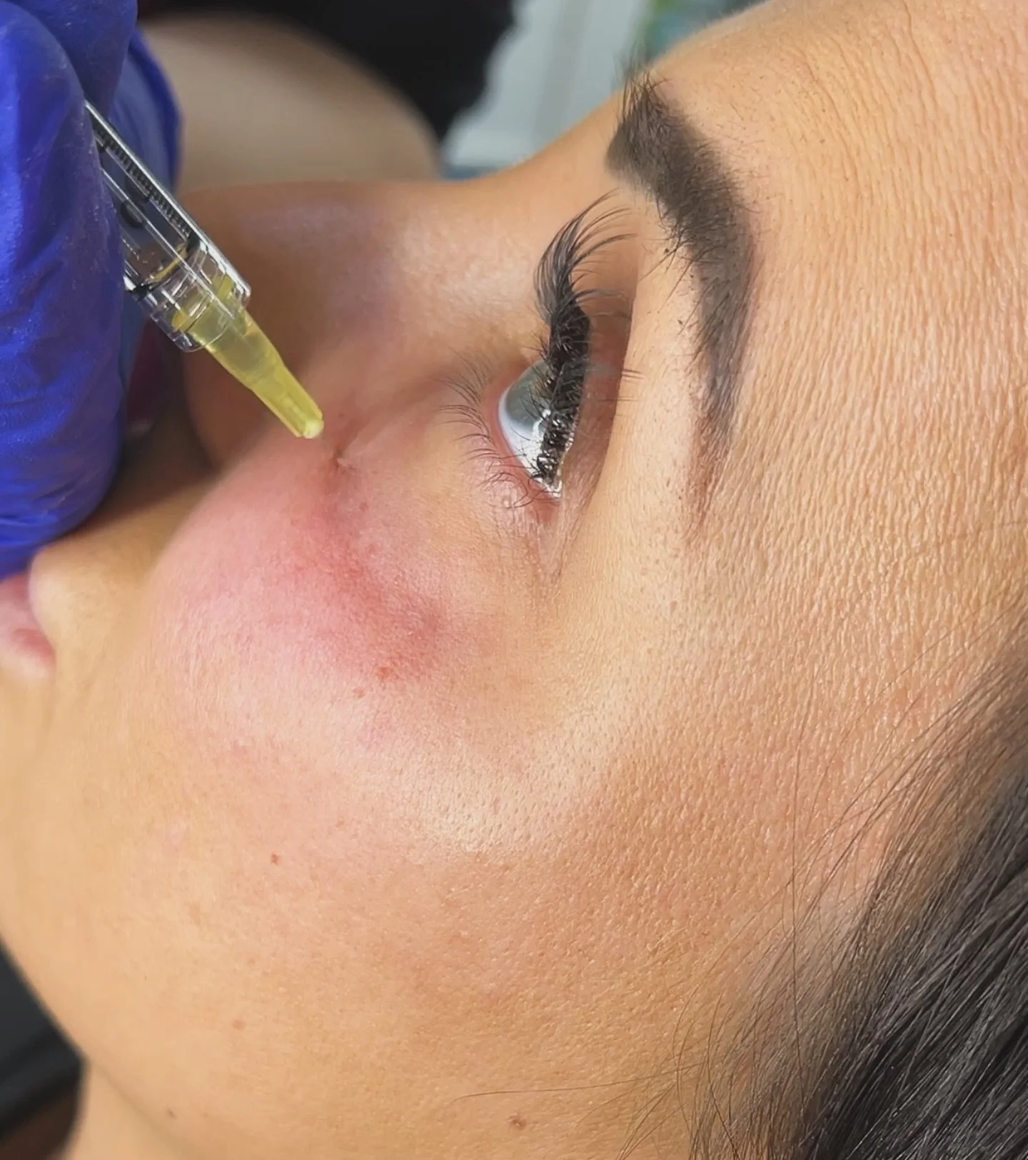What treatment are we doing here? 💉 

Comment below 👇 

#aestheticspractitioner #aesthetics #cosmeticinjector #eyesrejuvenation #holloweyes #advancedtechniques #dermalfillers #tweakments #artistwiththeneedle #sn_aesthetics