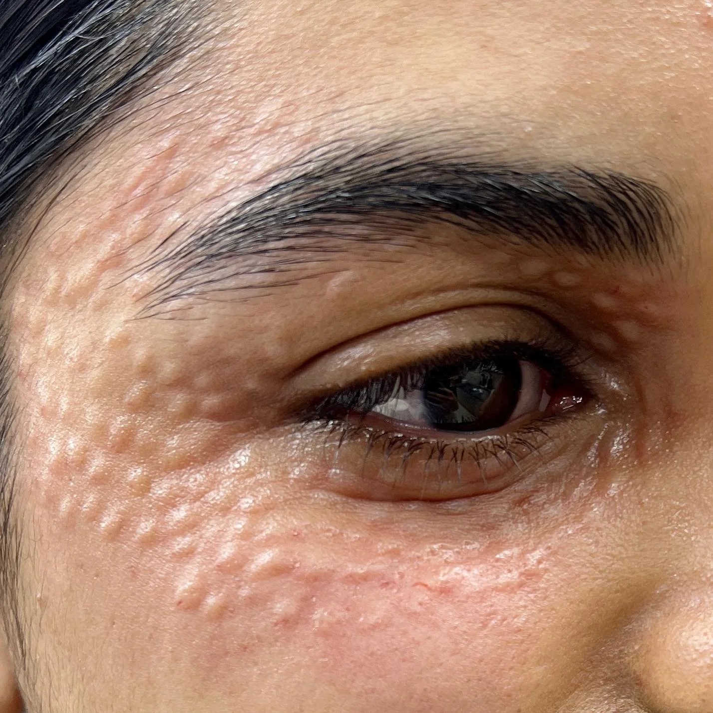 Polynucleotides Eye Treatment
Fresh off the needle! 💉✨

This powerful treatment promotes skin regeneration, improves skin laxity, reduces fine lines, and boosts hydration around the delicate eye area.

Tiny injection sites and swelling are completel