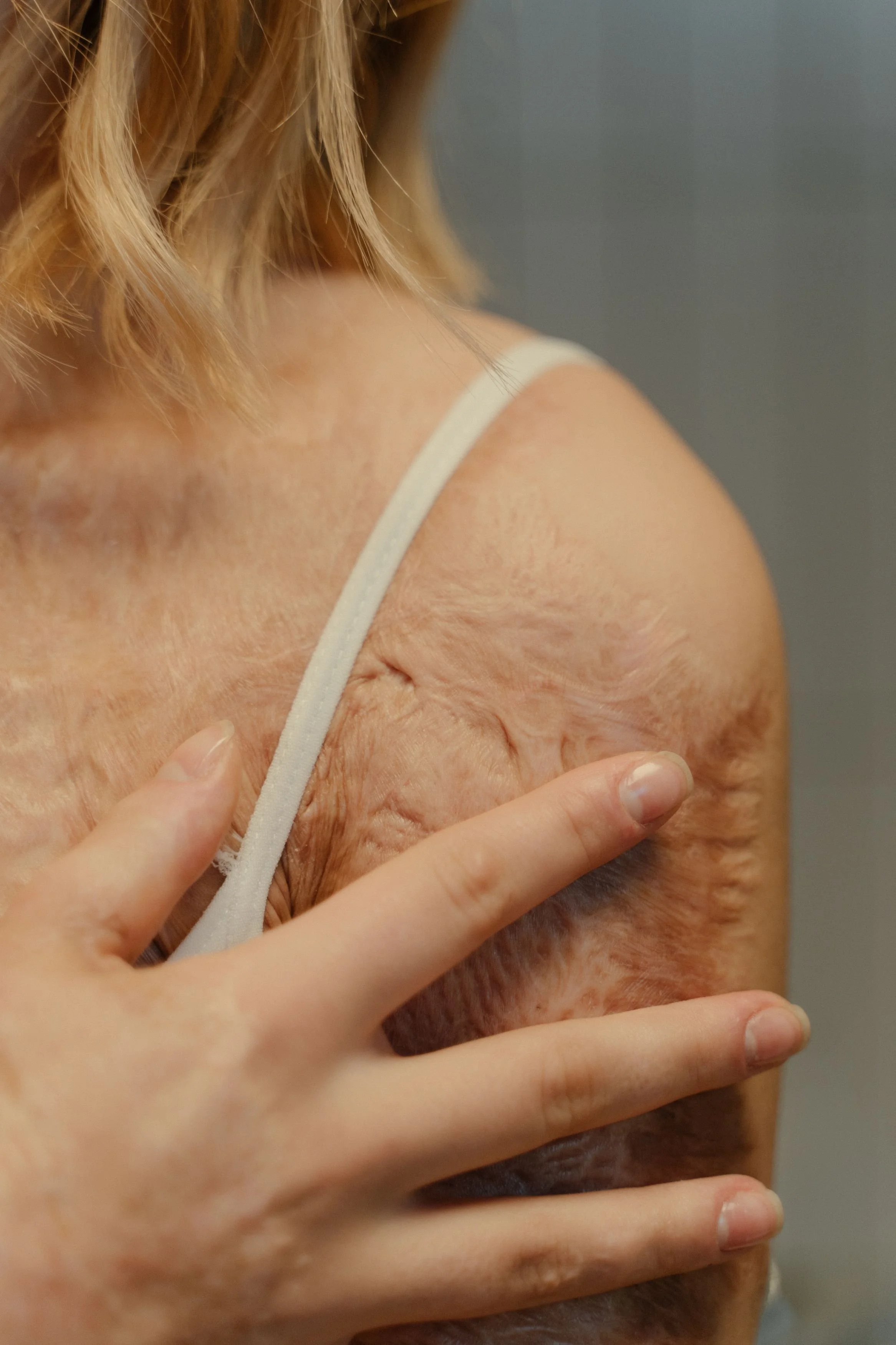 Scar Therapy in Integrative Medicine: When to Consider