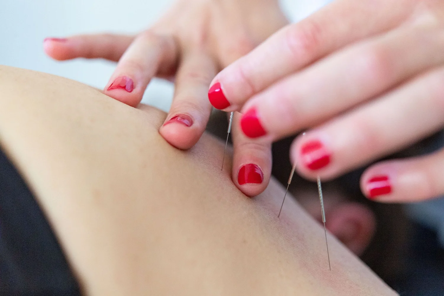 Physiotherapist performing dry needling at Base Physiotherapy & Pilates, Drummoyne