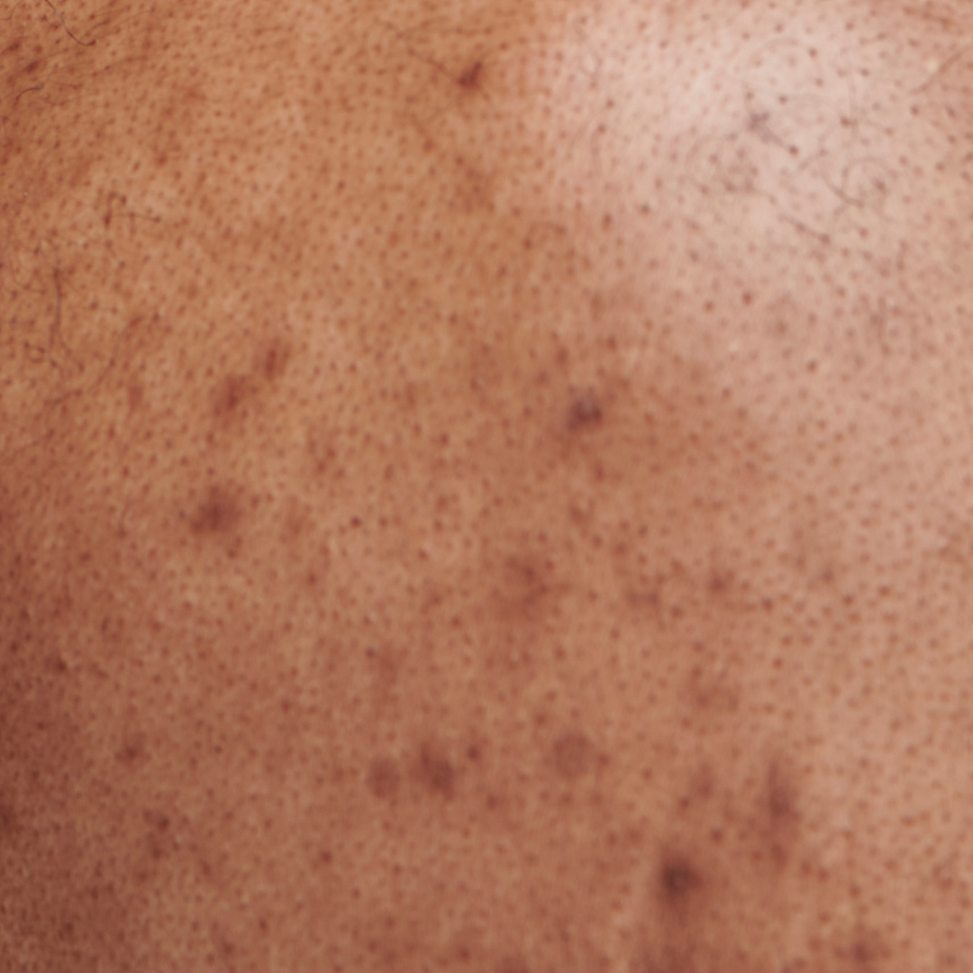 Hyperpigmentation.png