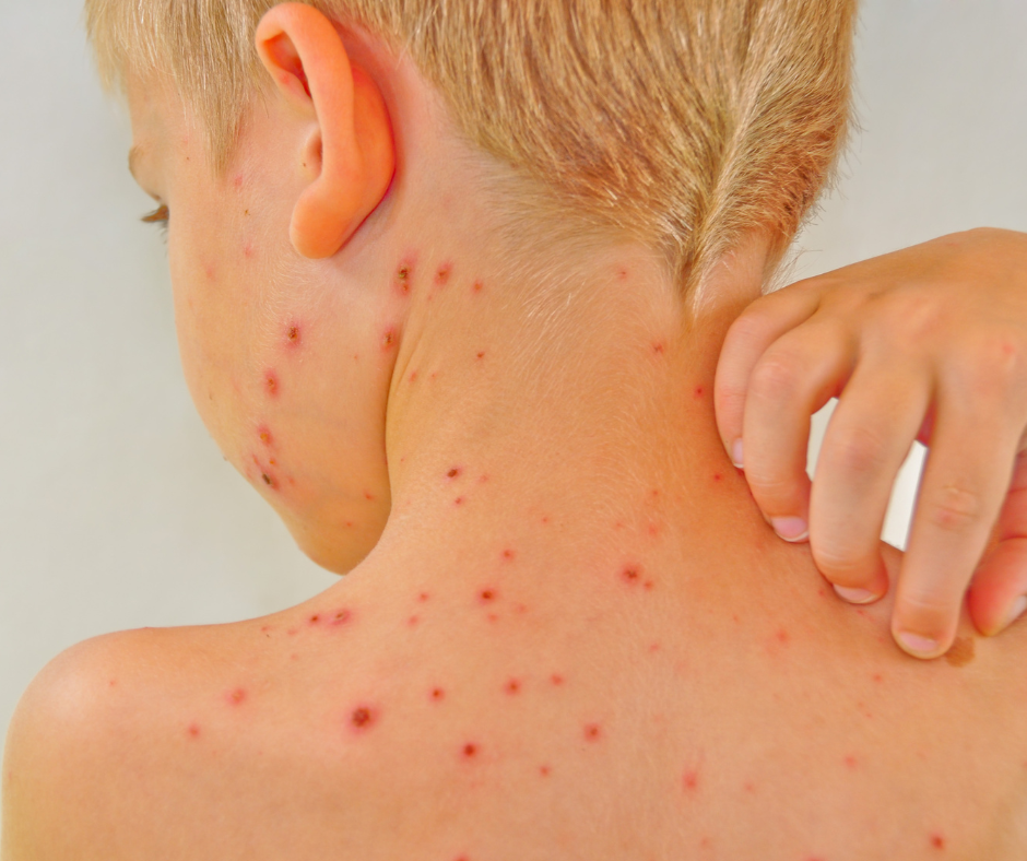 Chickenpox Vaccine: Who Should Consider It and Why It Matters