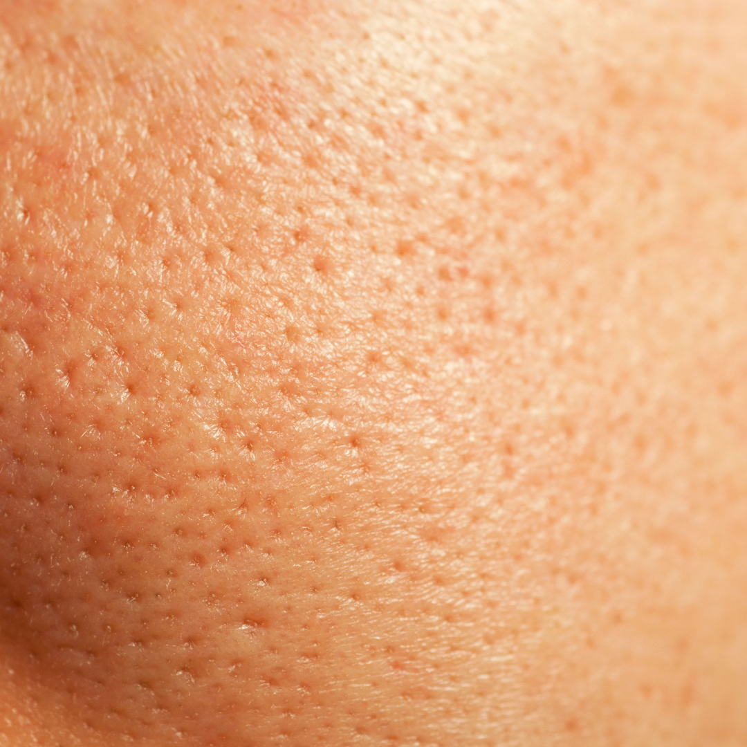 Pores.png