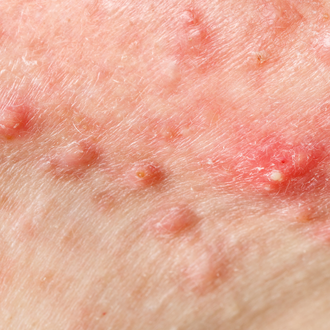 Acne.png