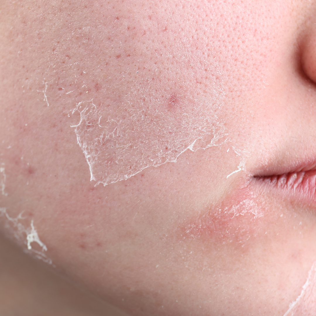 Dry skin.png