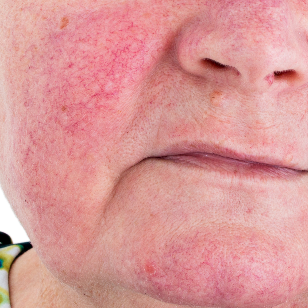 Rosacea.png