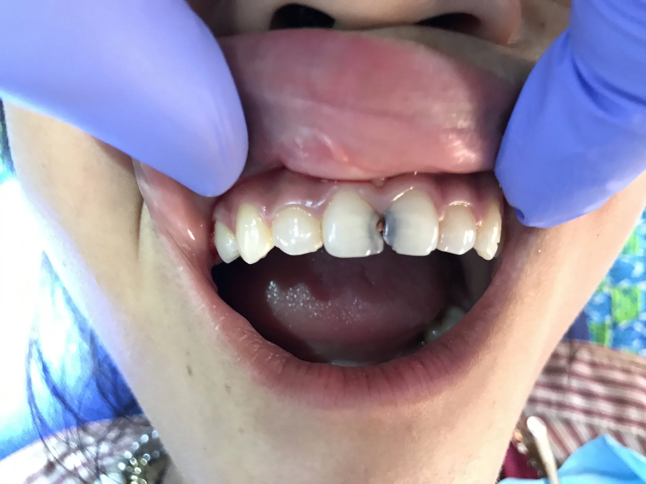 Cambodia 2017 case 1 before.JPG