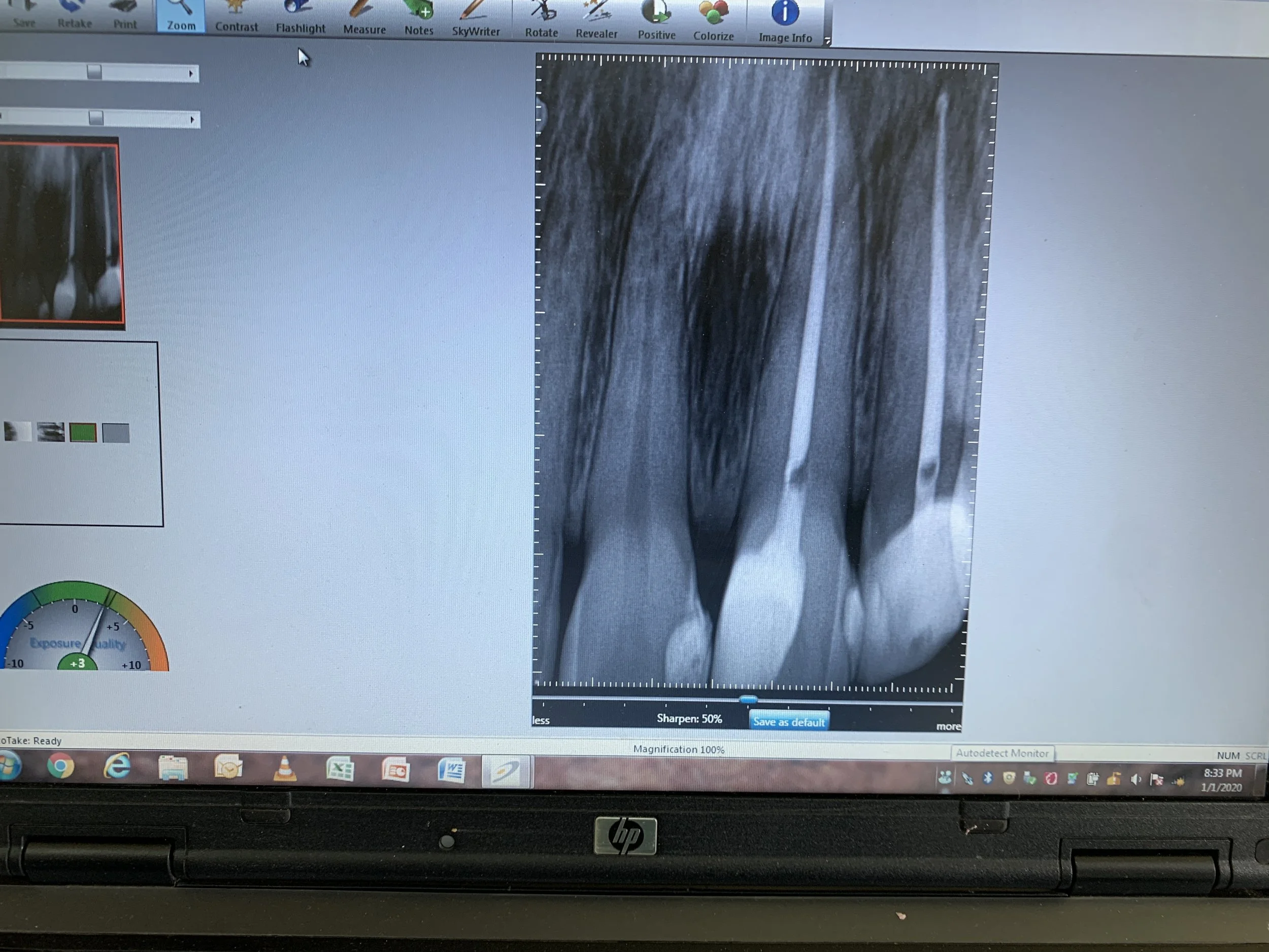 Cambodia 2019 case 2 after xray RCT's.JPG