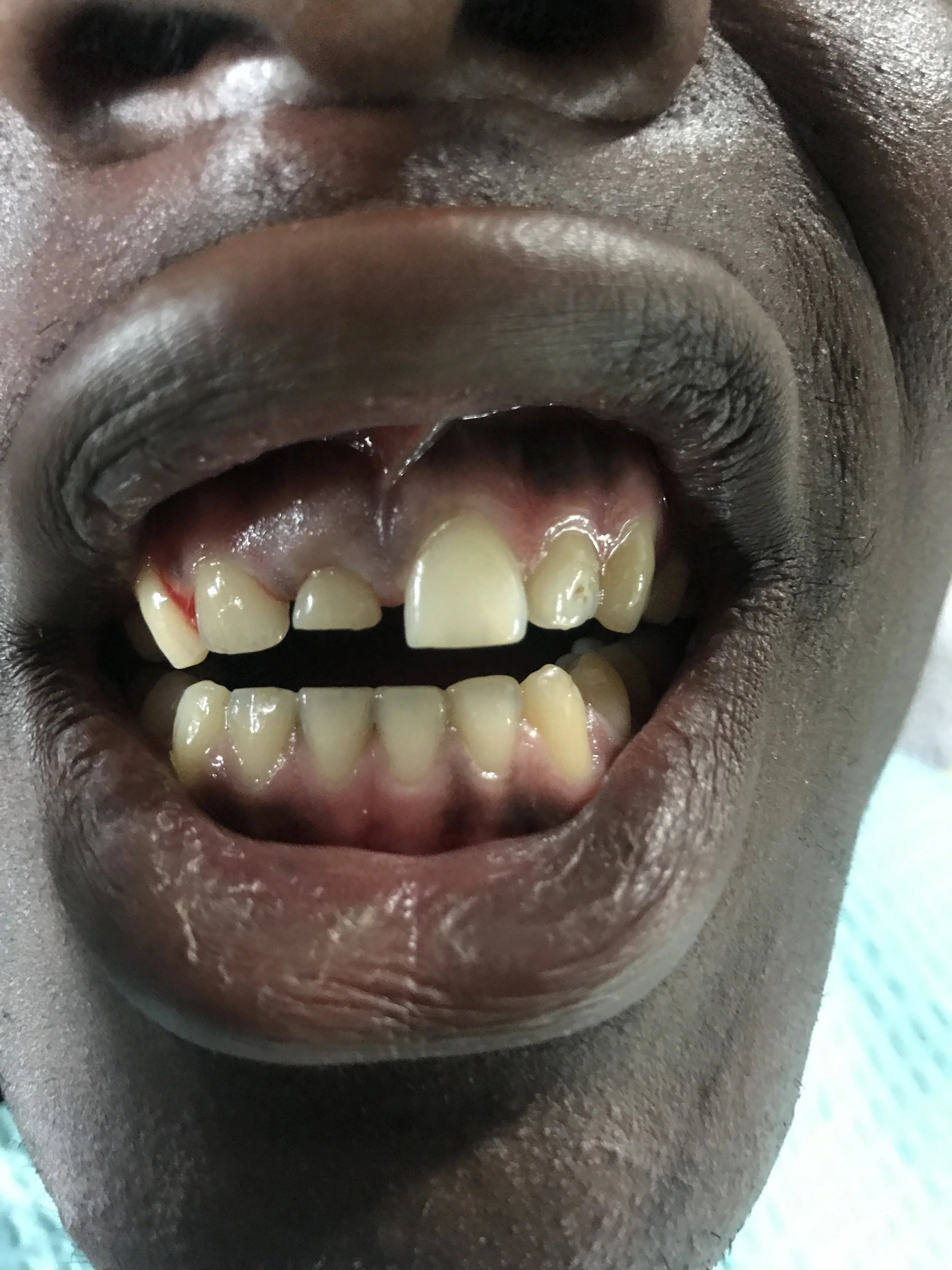 Uganda 2017 Case 1 Before.JPG