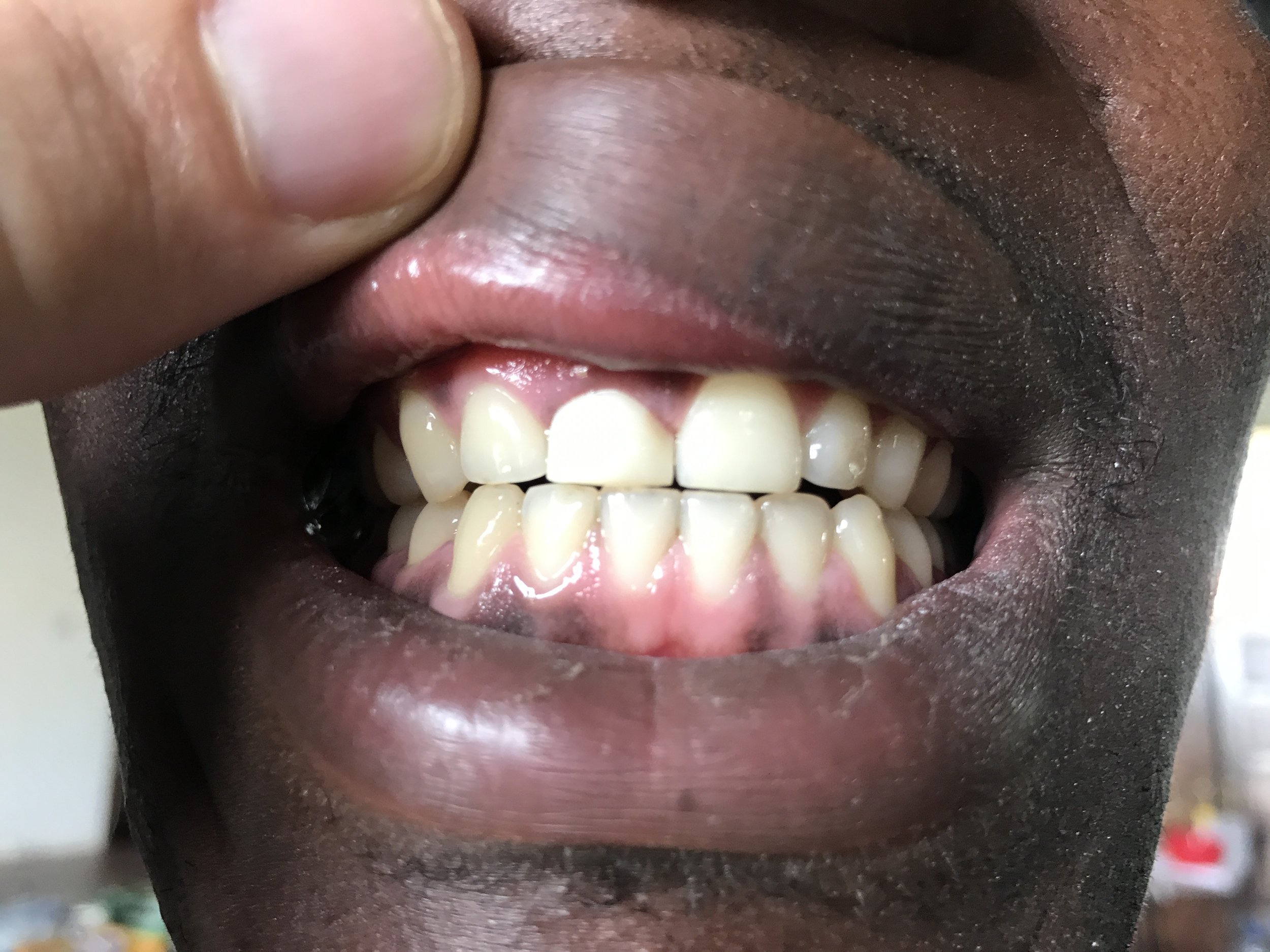 Uganda 2017 Case 1 After.JPG