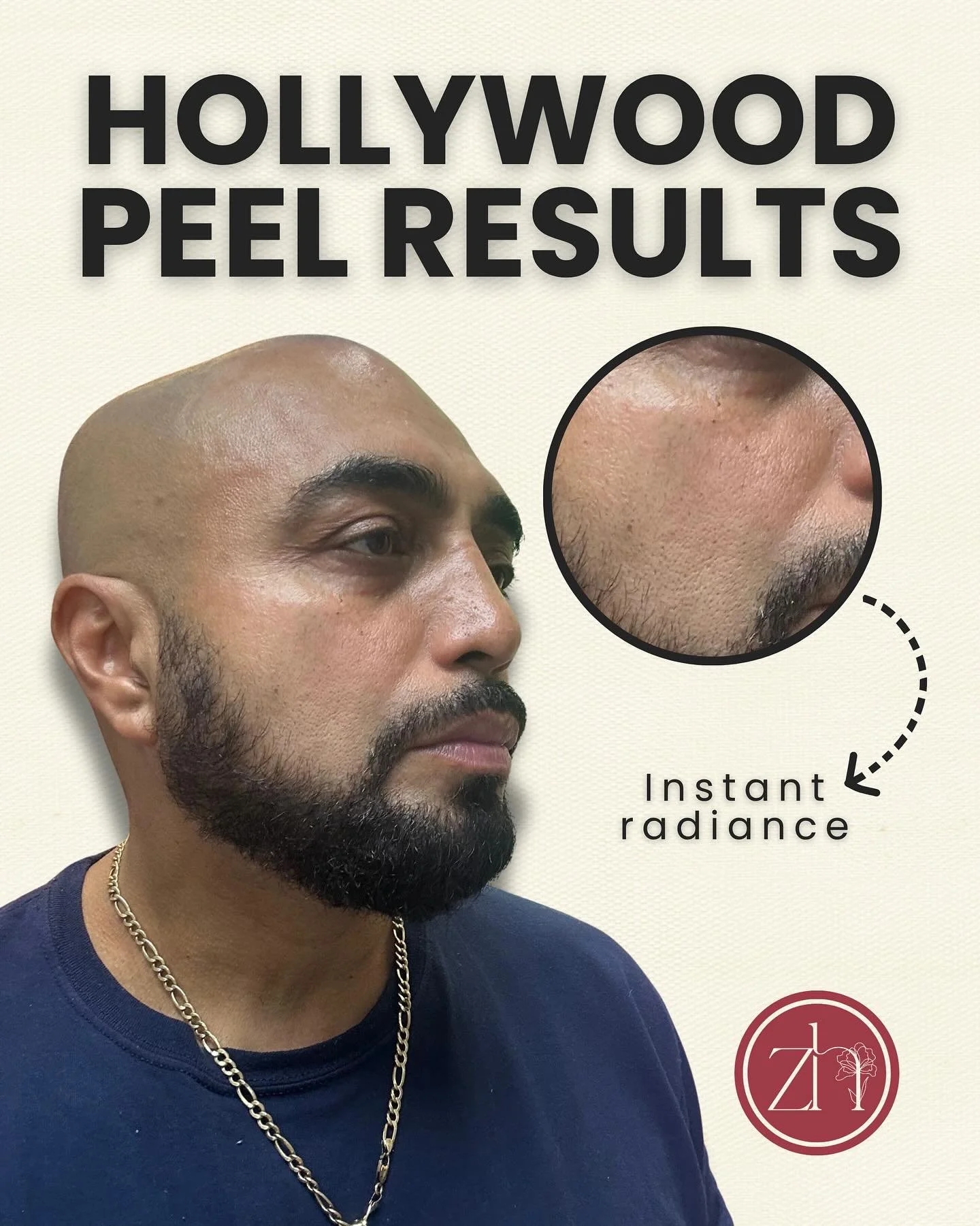 Look at our patient&rsquo;s instant glow after a Hollywood Peel session!✨

This gentle laser treatment helps smooth pores, even out skin tone, and bring back that healthy, radiant glow we all love. Perfect for a quick refresh before an event or as pa