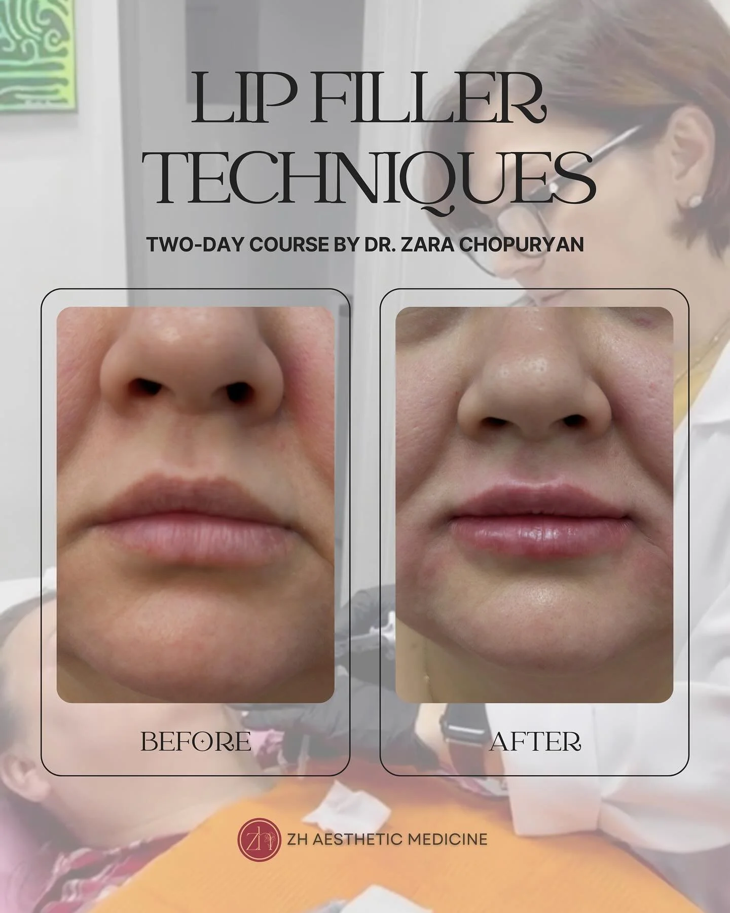 𝗥𝗲𝗮𝗹 𝗽𝗮𝘁𝗶𝗲𝗻𝘁𝘀. 𝗥𝗲𝗮𝗹 𝗿𝗲𝘀𝘂𝗹𝘁𝘀. 𝗥𝗲𝗮𝗹 𝗹𝗲𝗮𝗿𝗻𝗶𝗻𝗴. 💉

Guided by Dr. Zara, participants performed hands-on lip filler procedures on real patients &mdash; gaining practical experience and learning refined techniques. 👩&zwj