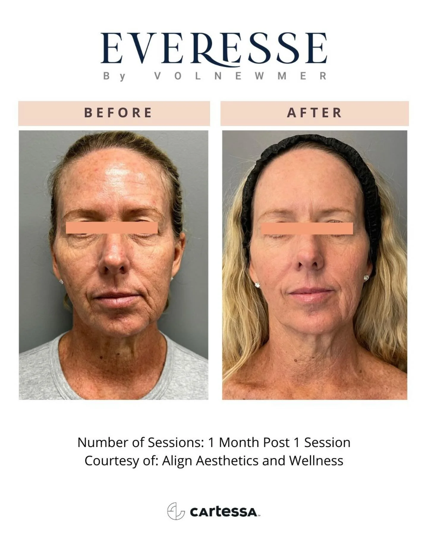 You HAVE to see these @everesse_skin results &mdash; thank you @cartessaaesthetics and  @alignaesthetics.vb for sharing! ✨

This is after just one session&hellip; and honestly, the one-month photo speaks for itself. This isn&rsquo;t &ldquo;a little g