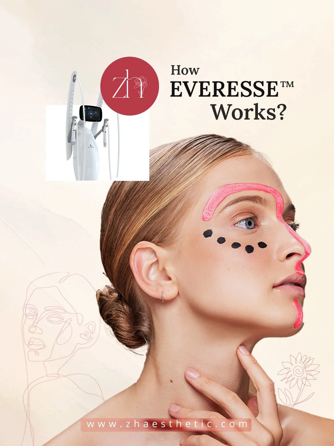 Key Benefits:✨

Lifting and Contouring: Improves the definition of the jaw, cheeks and facial contour.

Firming: Reduces sagging in the face, neck and body (arms, abdomen).

Volume and Brightness: Provides a natural filling effect and improves skin t