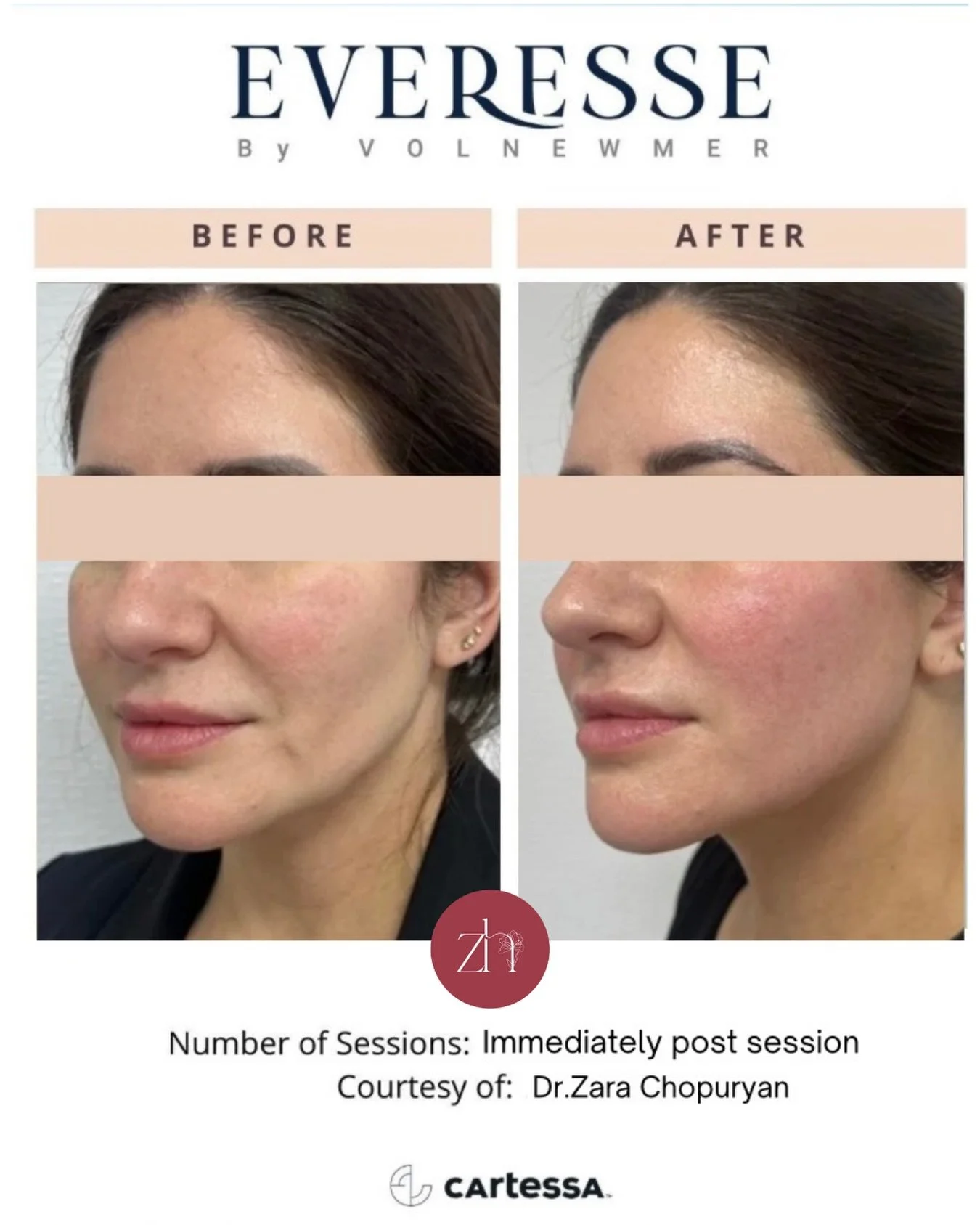 A subtle lift. A more defined jawline and chin. A rejuvenated lower face without surgery
@everesse_skin works to firm the skin, improve its quality, and restore some of the volume lost due to the decline in collagen that occurs over the years.

Evere