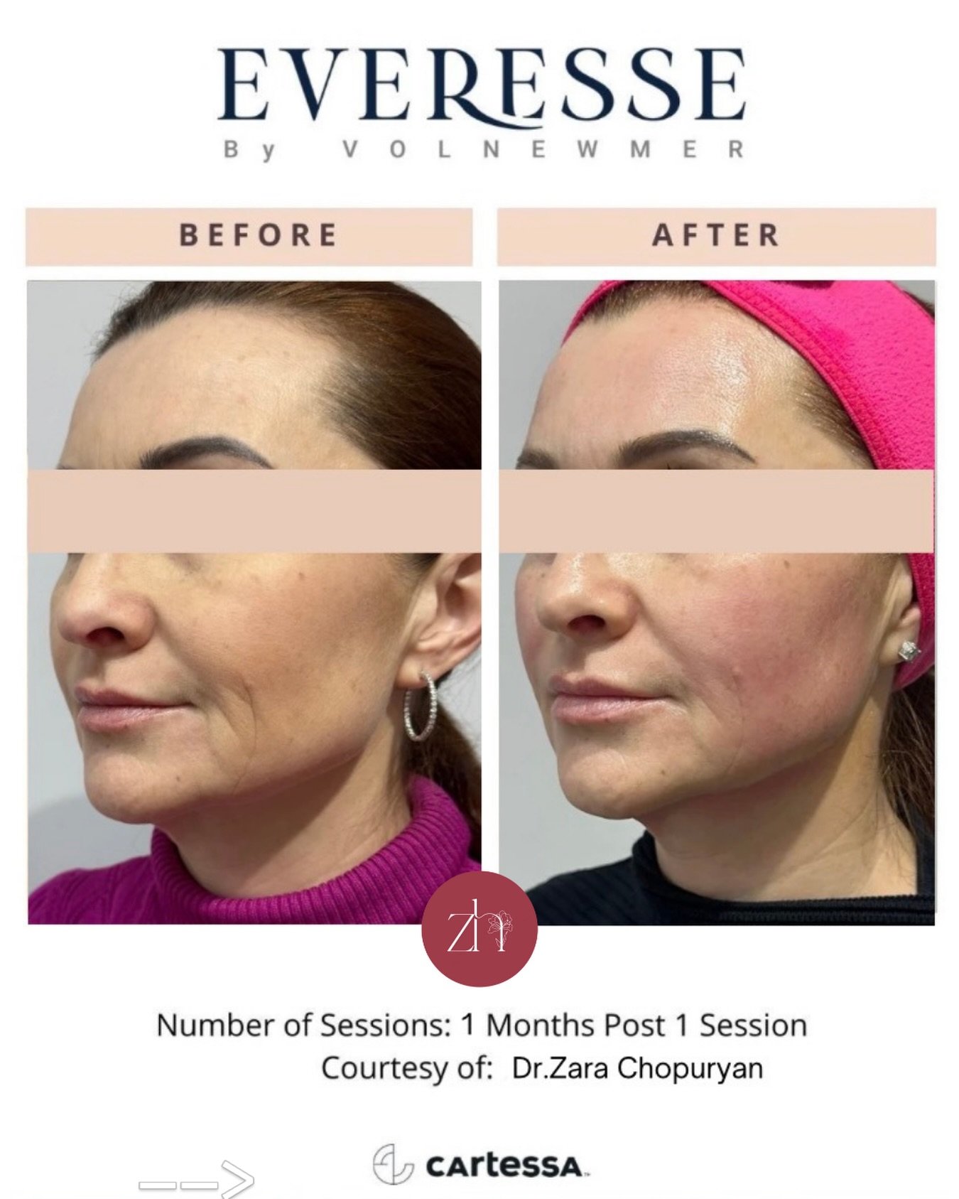✨A visibly firmer, more defined, and radiant face, Before and after&mdash;right after the treatment! 

Our @everesse_skin radiofrequency lifting treatment instantly firms, smooths, and restores that youthful contour that fades over time. See how your