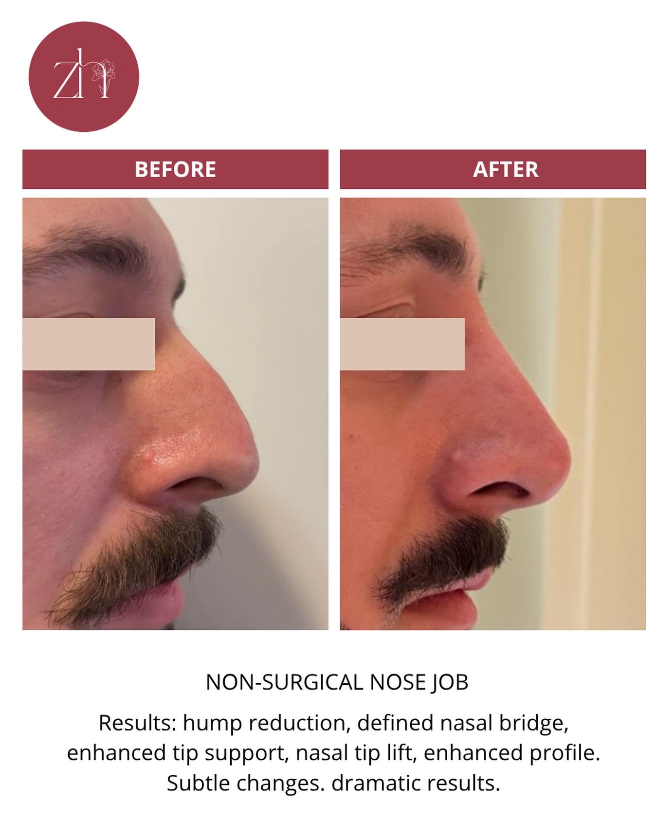 Before ➡️ After: Non-Surgical Nose Straightening for Men
No scalpel. No downtime. Just subtle contouring and improved symmetry using advanced dermal filler techniques.⁠

The goal is always to achieve a natural result that harmonizes with the facial p