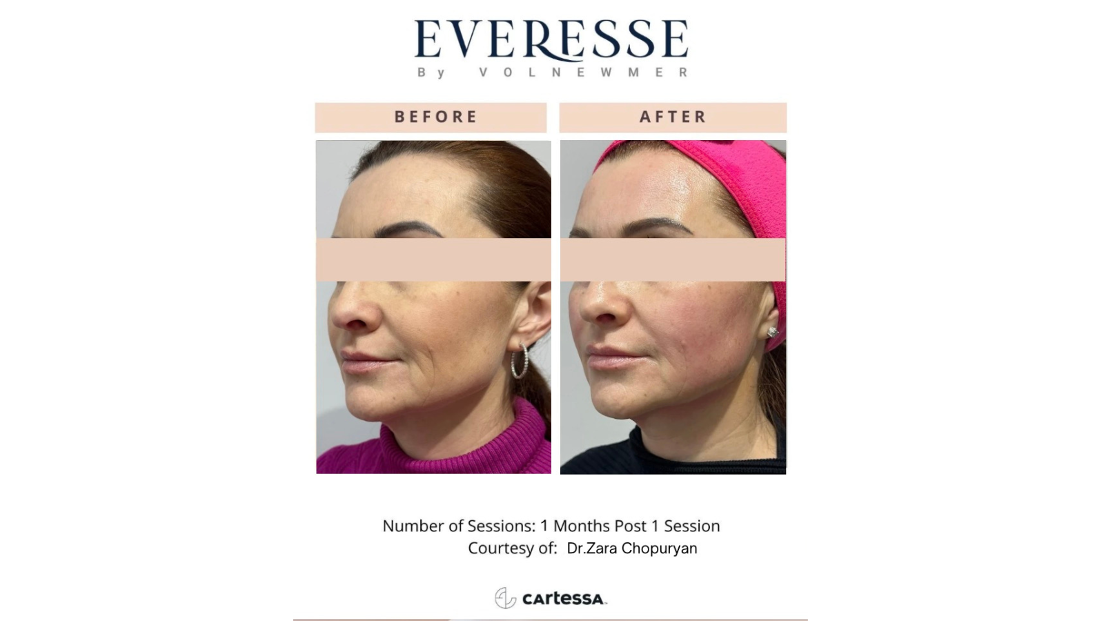 Everesse By Volnewmer, Manhattan