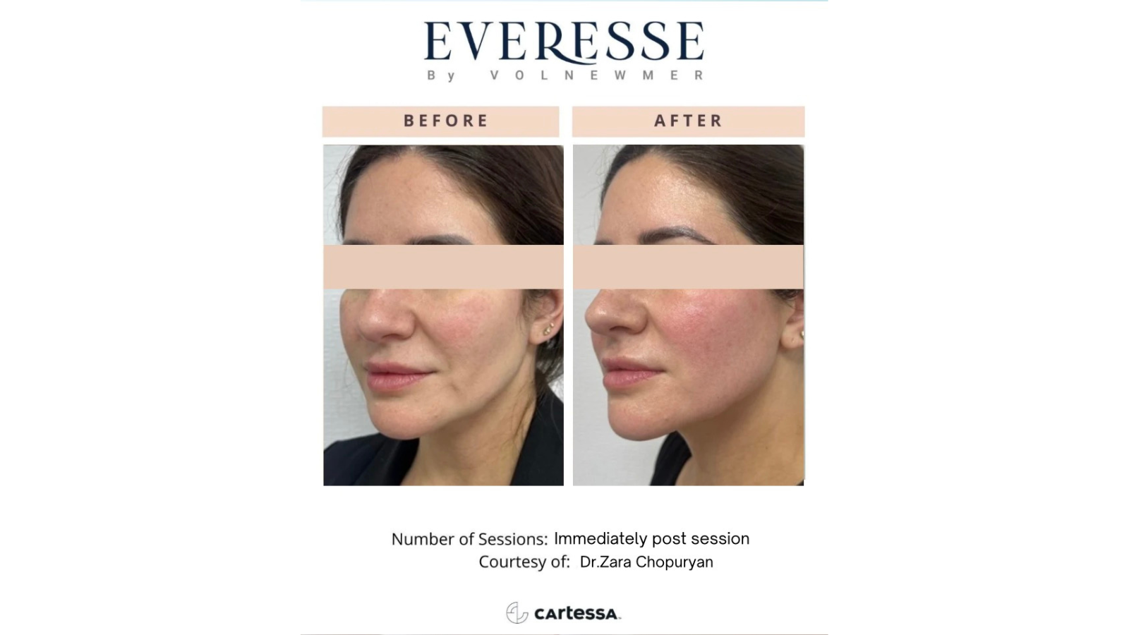 Everesse By Volnewmer NYC