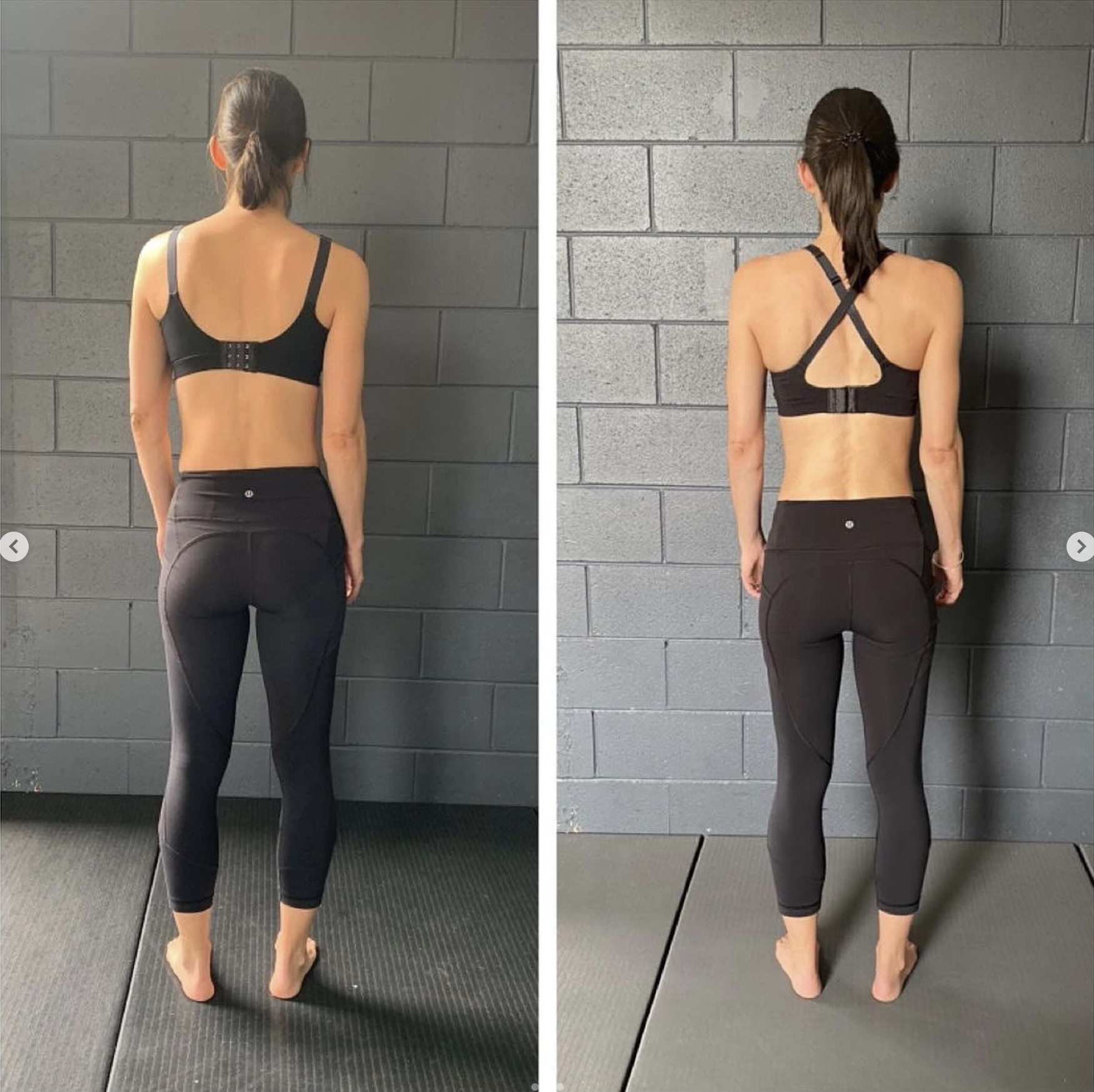 natural scoliosis correction gold coast