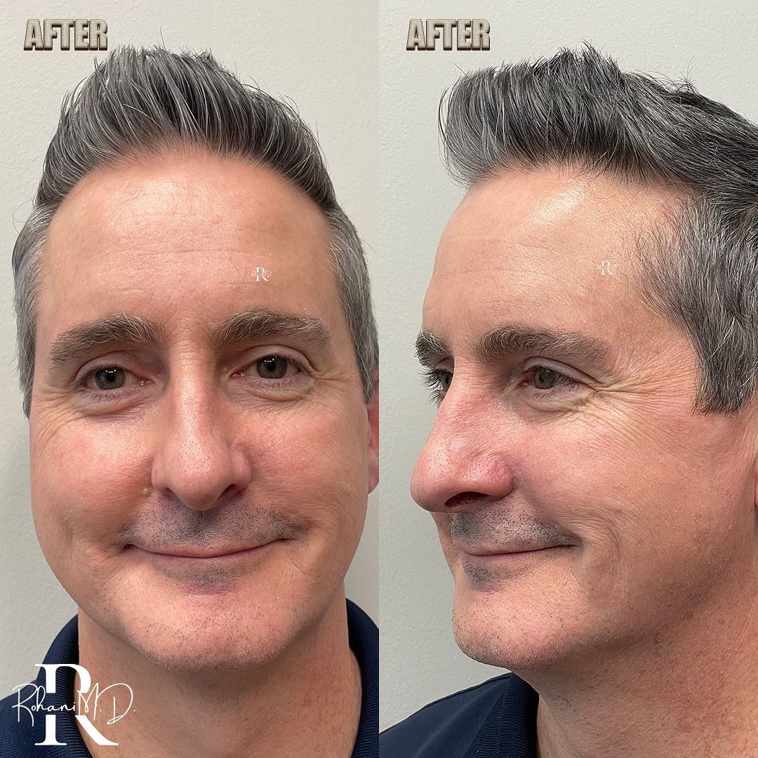 This gentleman was referred to me with a &ldquo;sclerosing&rdquo; basal cell carcinoma. This type of skin cancer often starts as a minimally-noticeable scar-like blemish. Patients frequently ignore them in the beginning because they don&rsquo;t look 