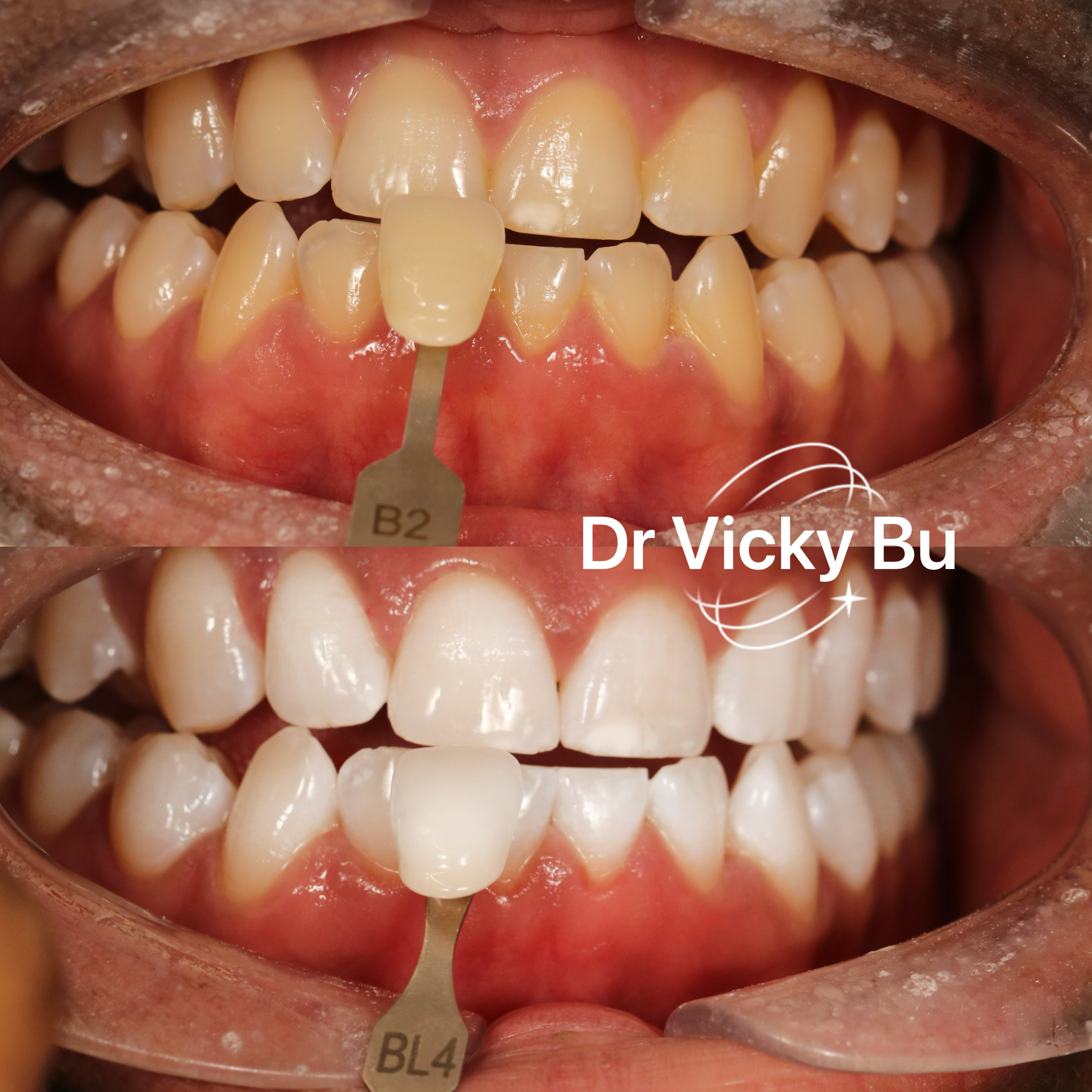 Non-sensitivity teeth whitening 