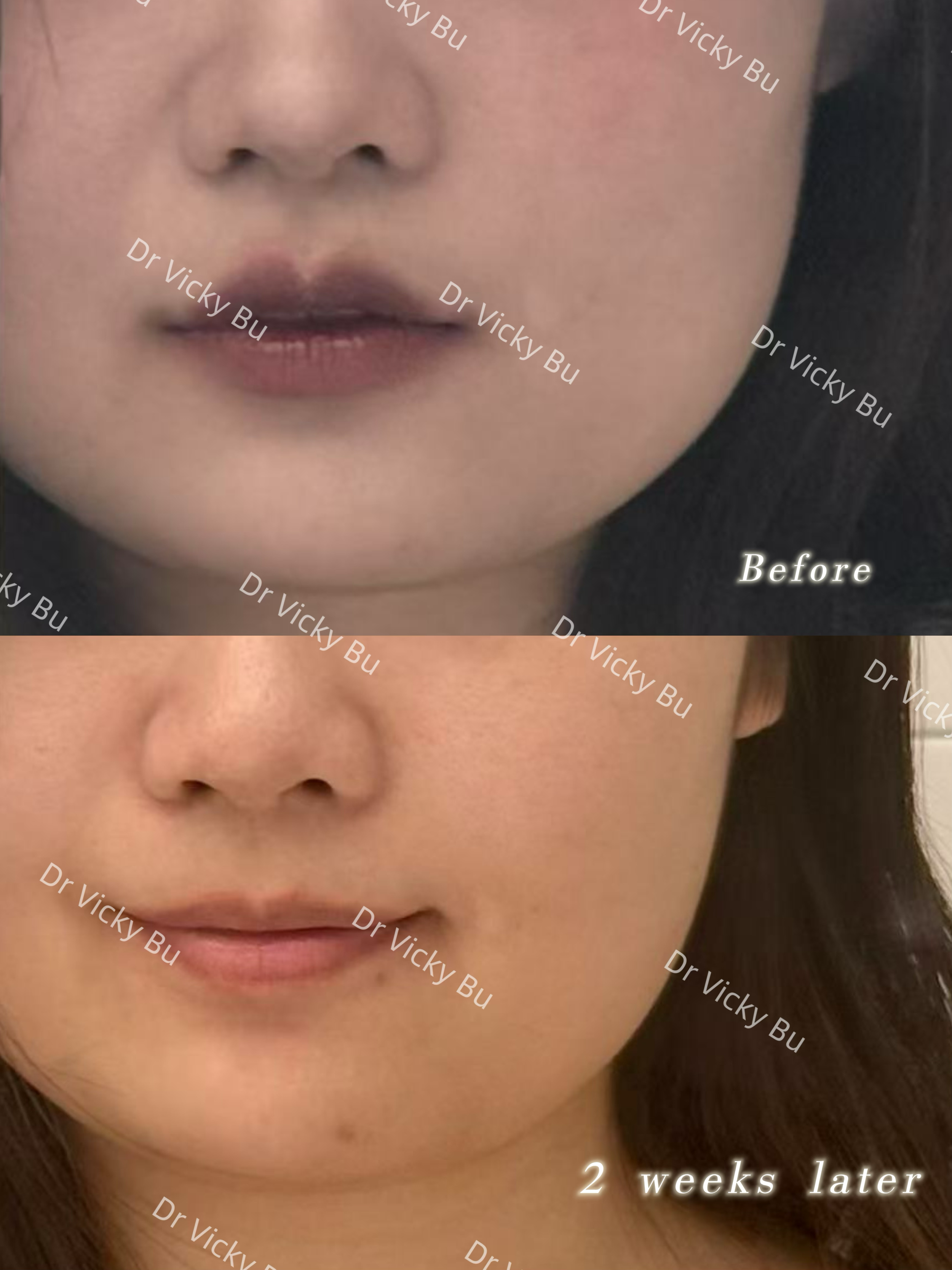 Masseter face slimming botox