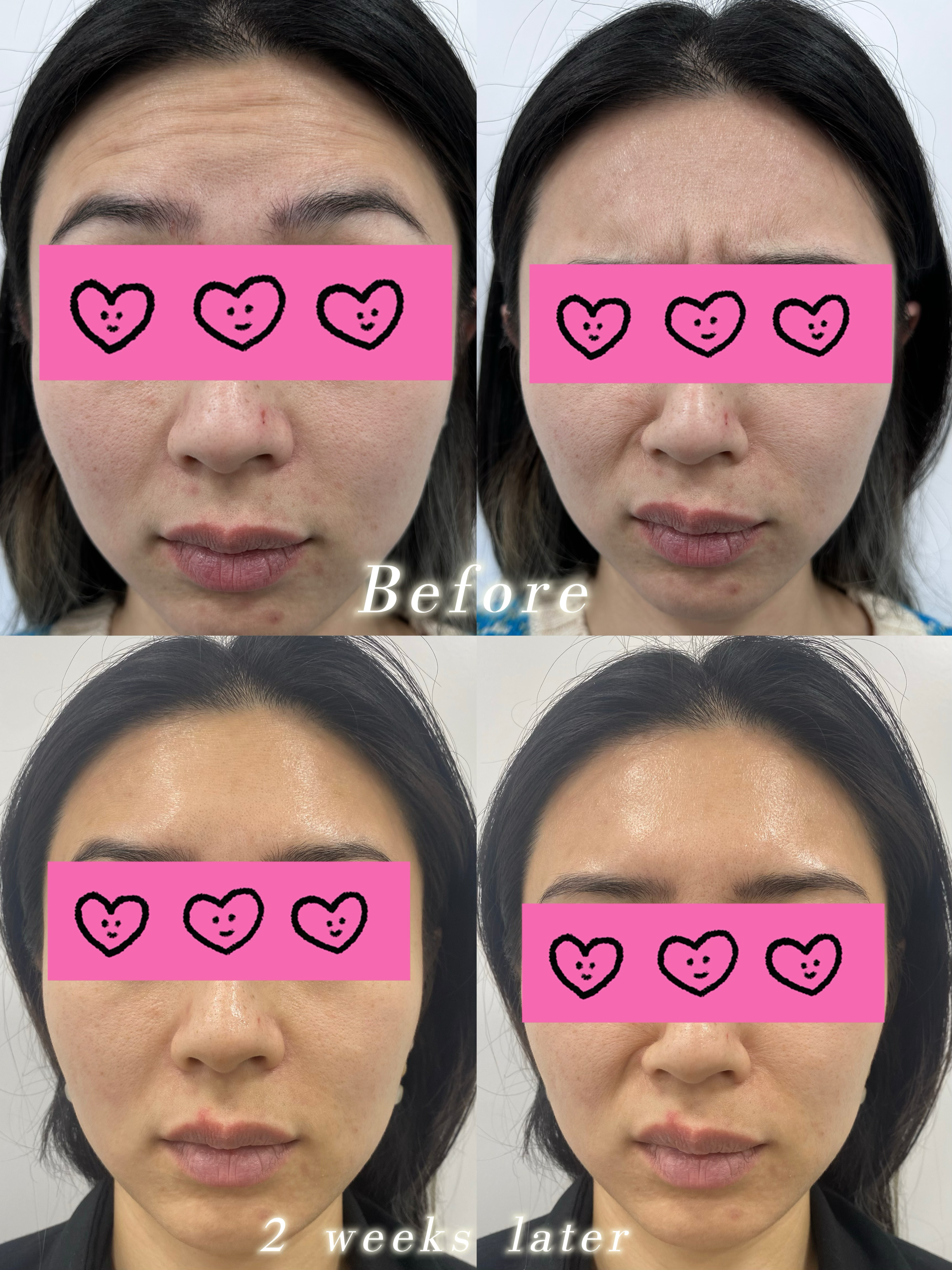 anti-wrinkle treatment 