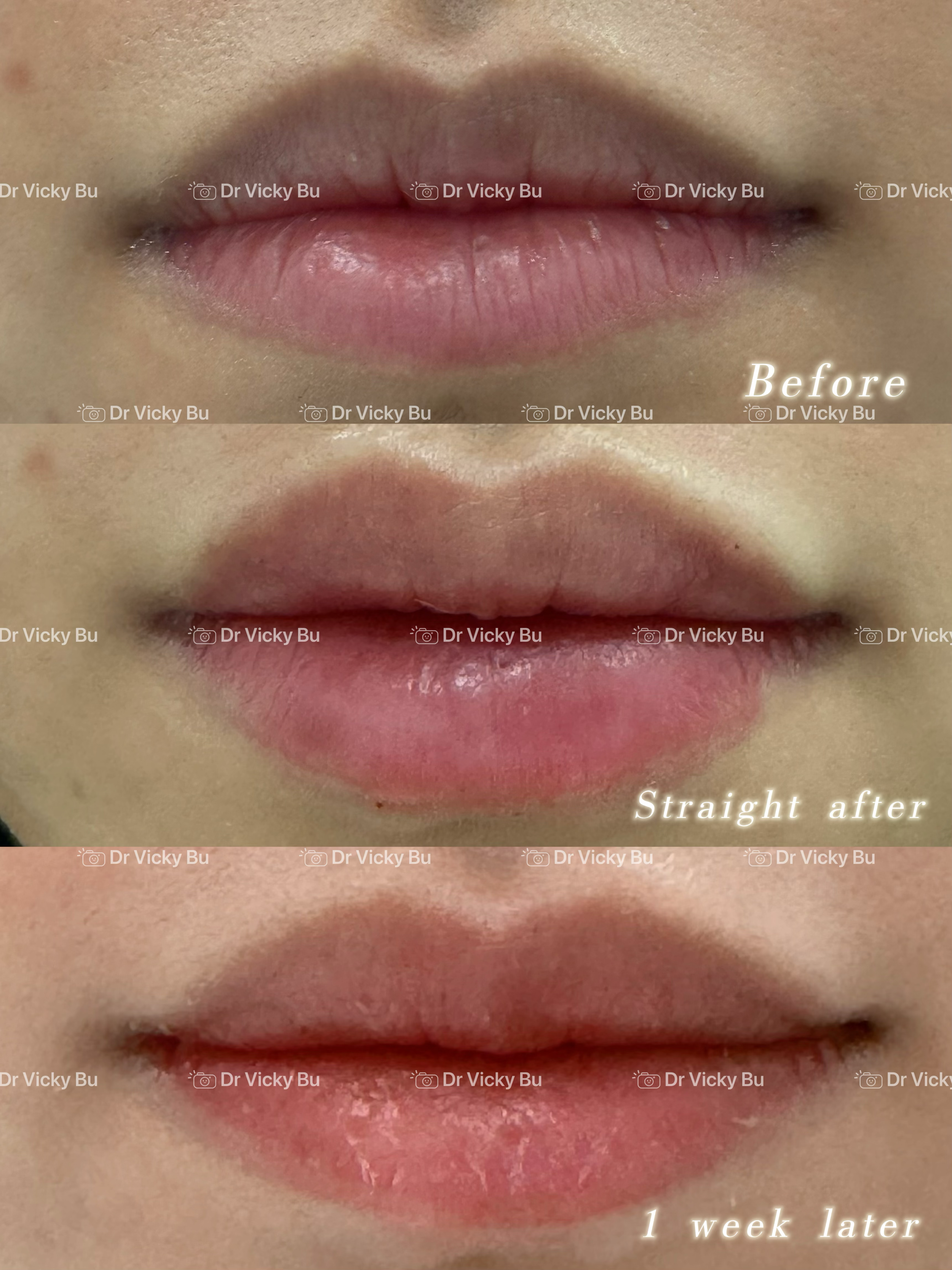 lip rejuvenation 