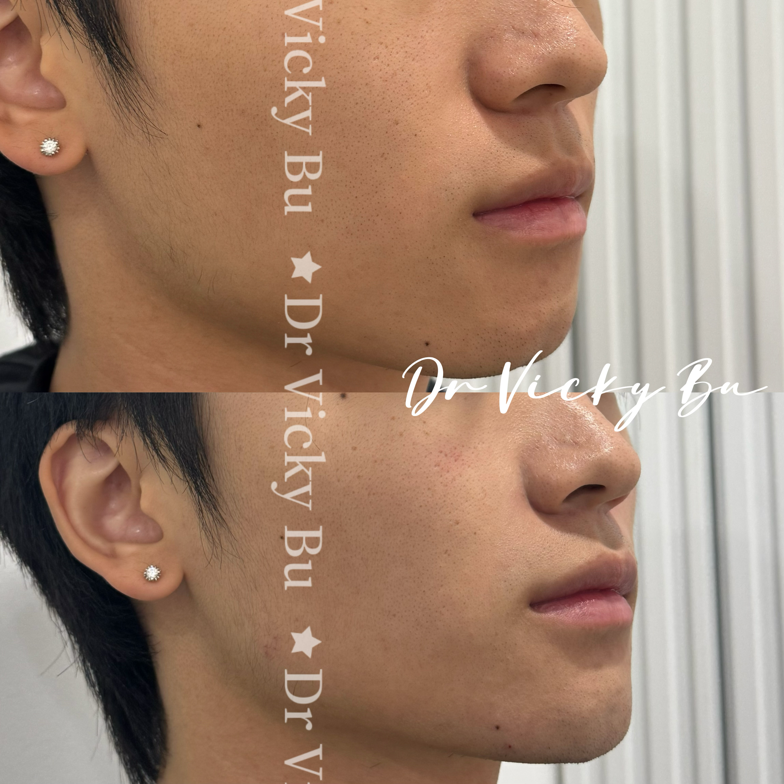 Chin augmentation 