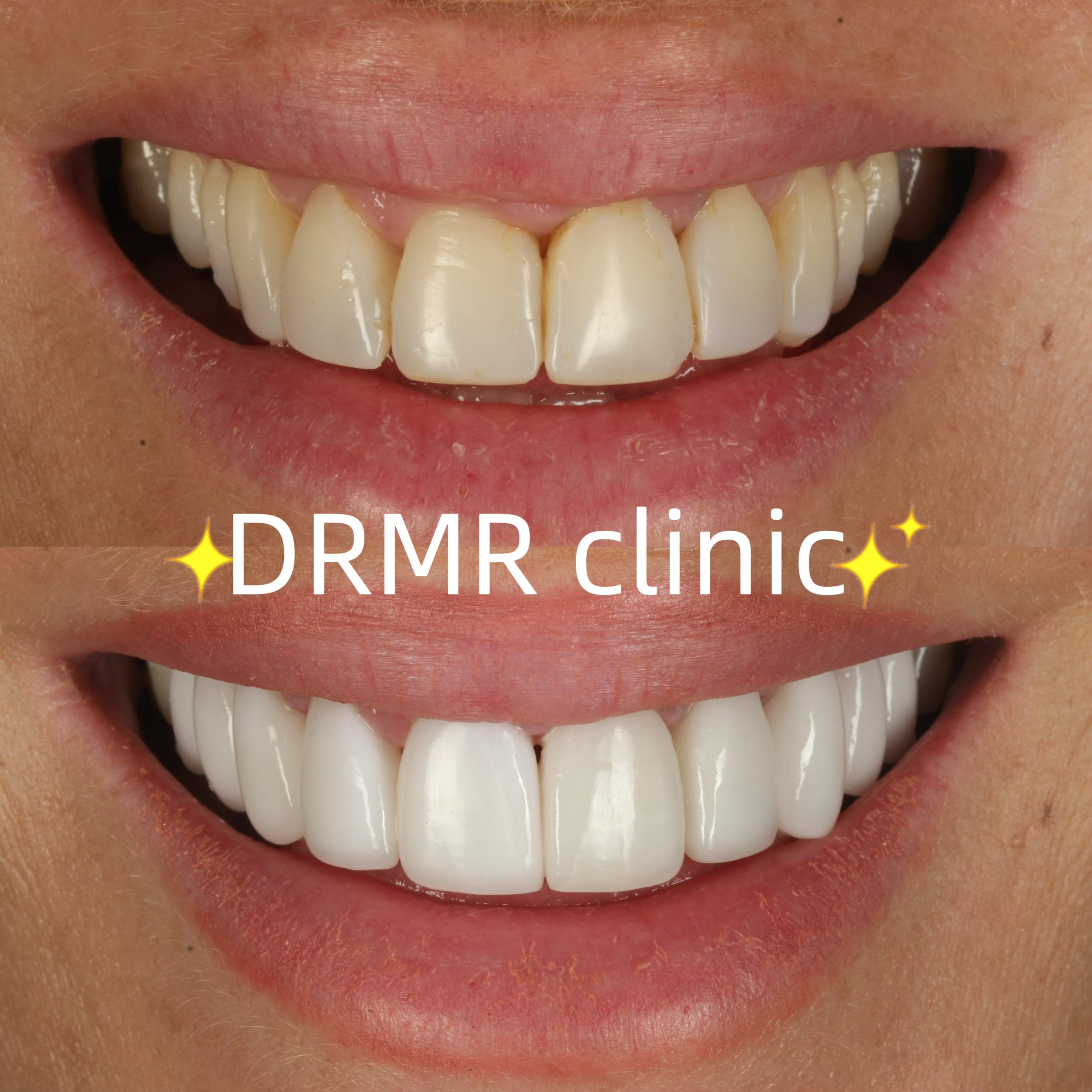 Full mouth porcelain veneers 