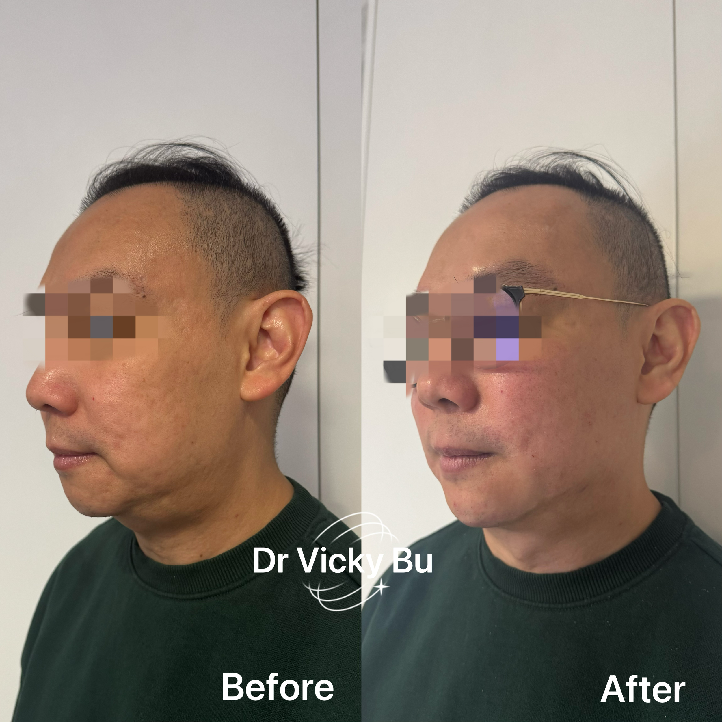 Bespoke full face rejuvenation and lifting 