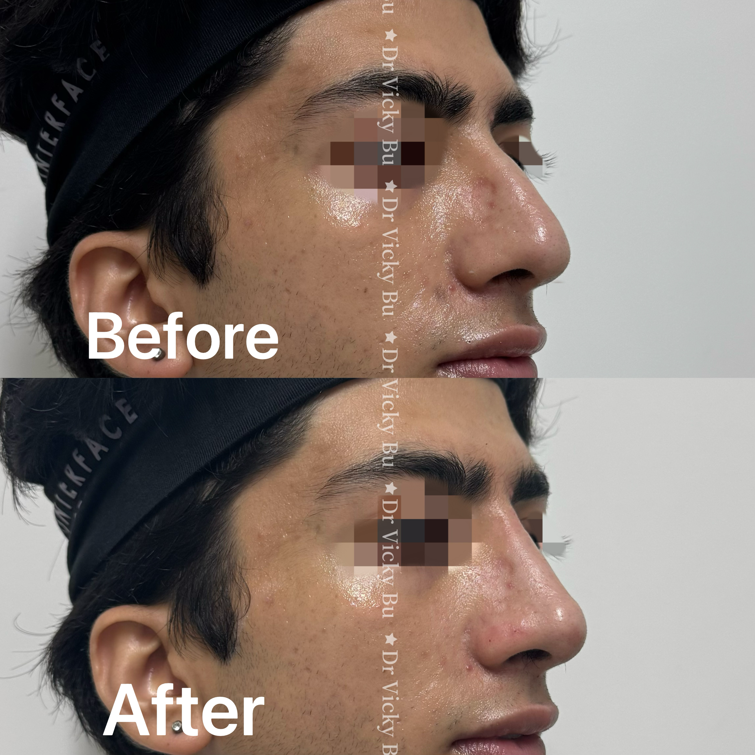 Non-surgical Rhinoplasty 