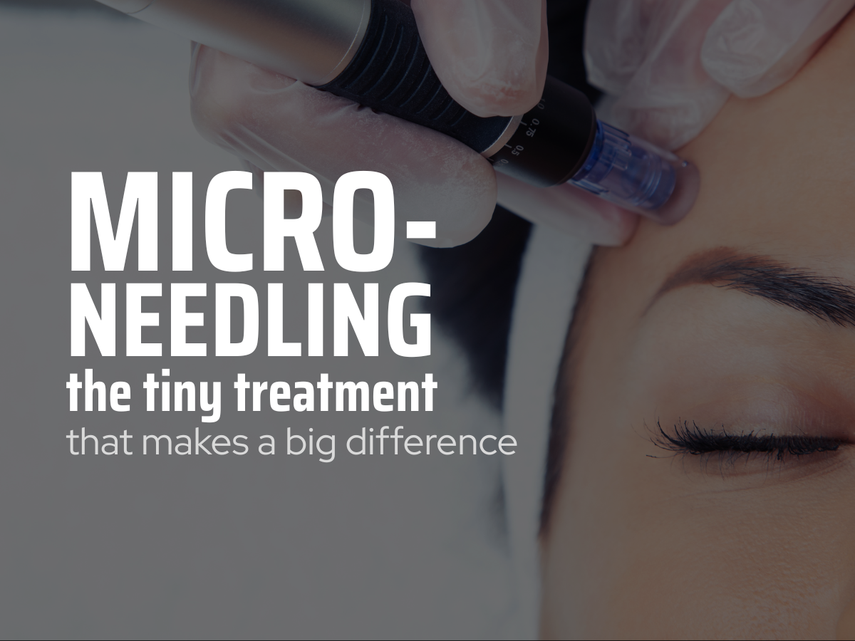Microneedling: The Tiny Treatment That Makes a Big Difference